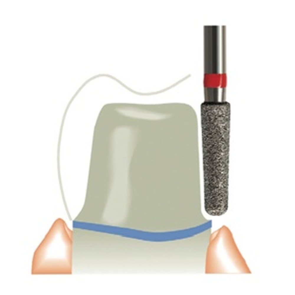 Frank Dental Tapered Round Diamond Bur FG TR (Made in Germany)