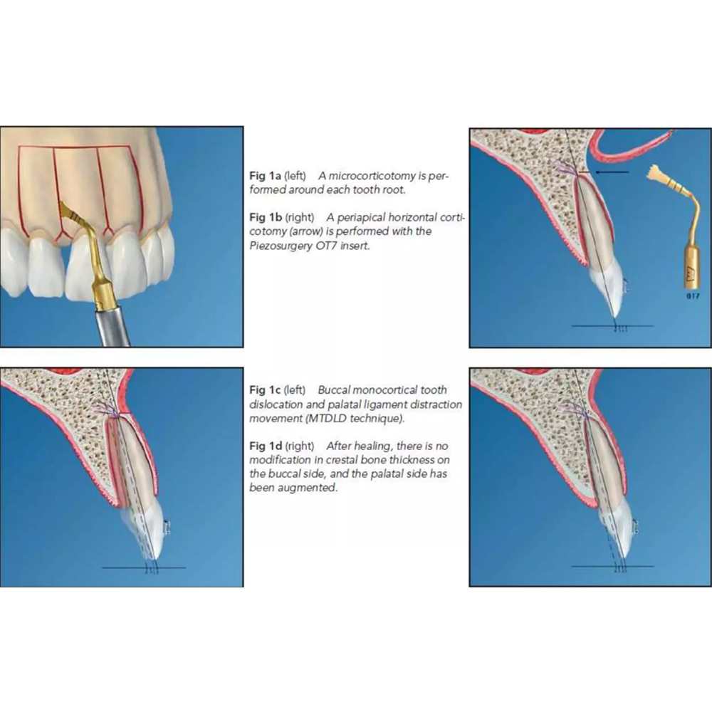 Woodpecker Piezo Bone Surgery Tips