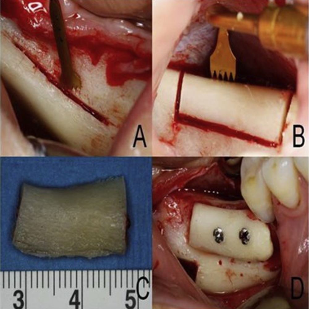 Woodpecker Piezo Bone Surgery Tips