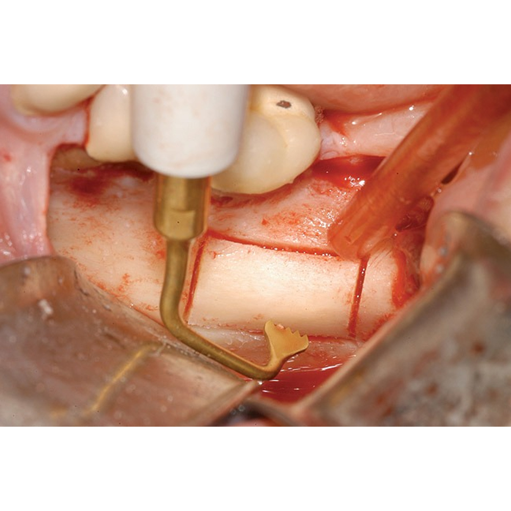 Woodpecker Piezo Bone Surgery Tips