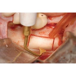 Woodpecker Piezo Bone Surgery Tips - 32