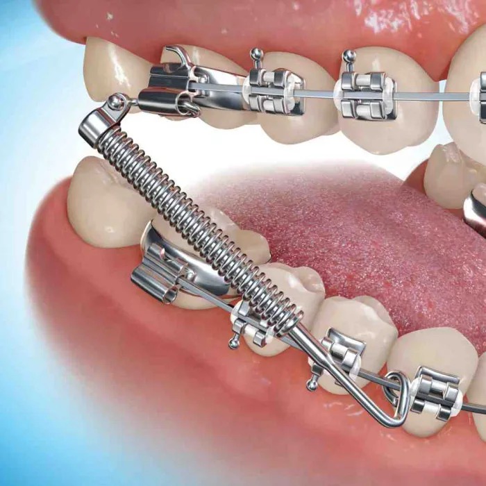 3m Unitek Gemini Metal Twin Brackets