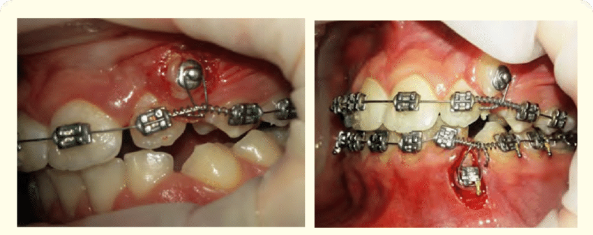 U Ortho Bondable Lingual Buttons Round (10/pk)