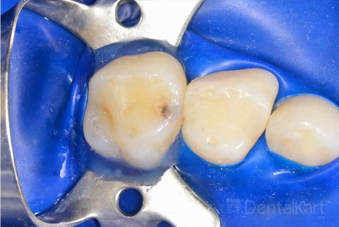 Waldent Rubber Dam Clamps Pedo