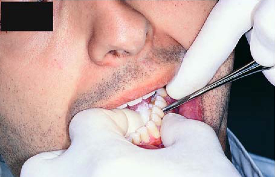 Waldent Root Elevator Instruments Kit Set of 11 K2/4