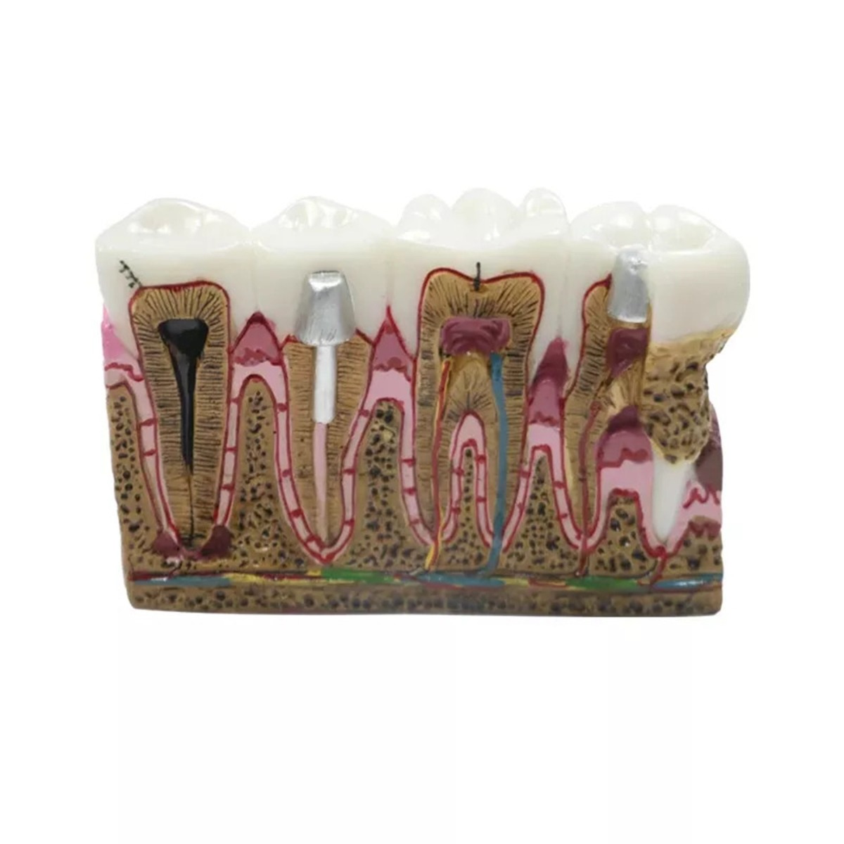 iDENTical Diseased Teeth and Gums Model M4029