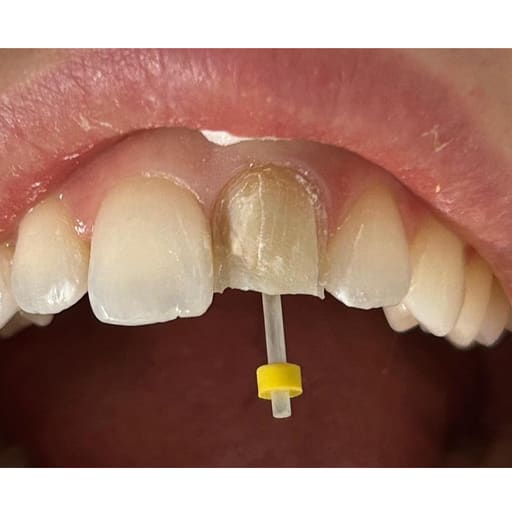 AAA Dental Fiber Post Kit (Pack of 20 Posts + 4 Drills)