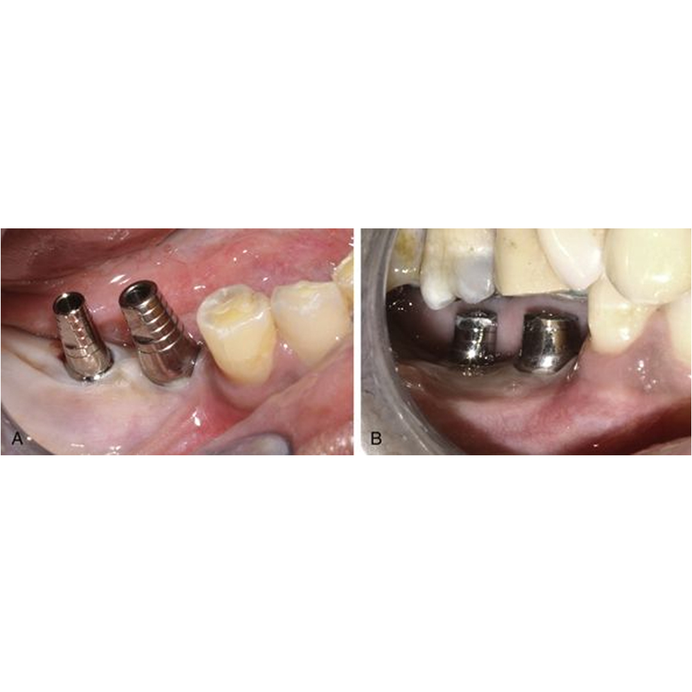 Nextin Straight Titanium Abutment Wide - Hex 5mm x G/H 2.2mm x 11.2mm (P611)