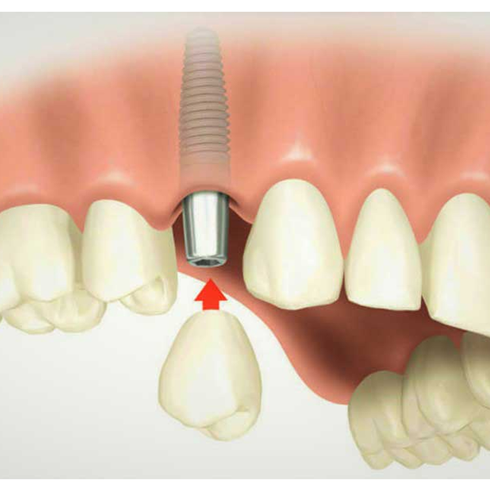 Nextin Straight Titanium Abutment No End Line - Hex 4.5mm x G/H 1mm x 10.4mm (P2810)