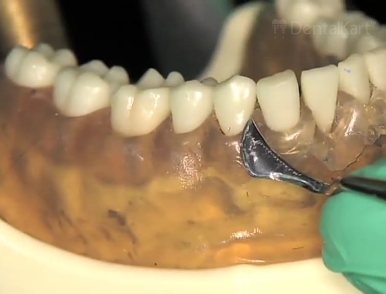 Waldent Periodontal Knives