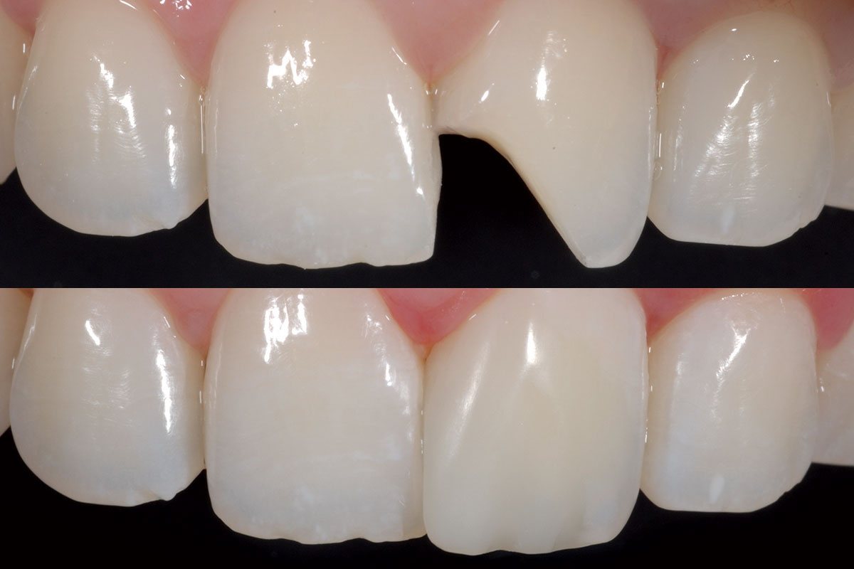 Prevest Denpro Fusion Universal Composite Intro Kit