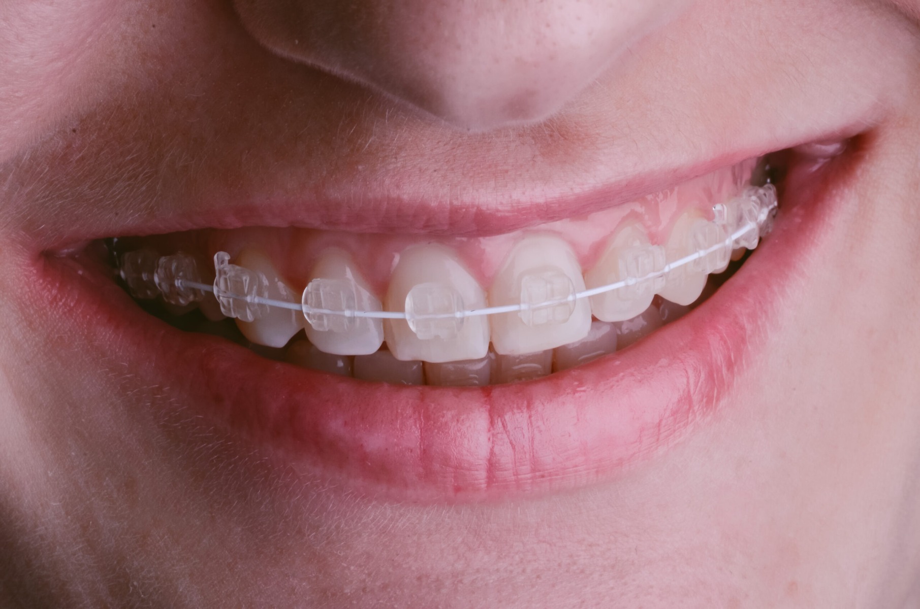 Phyx Nova Ceramic Brackets