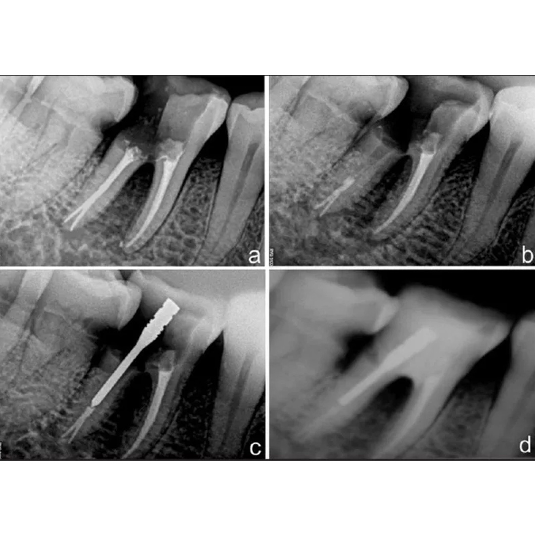 Prime Dental i Post Endodontic Metal Post Refills