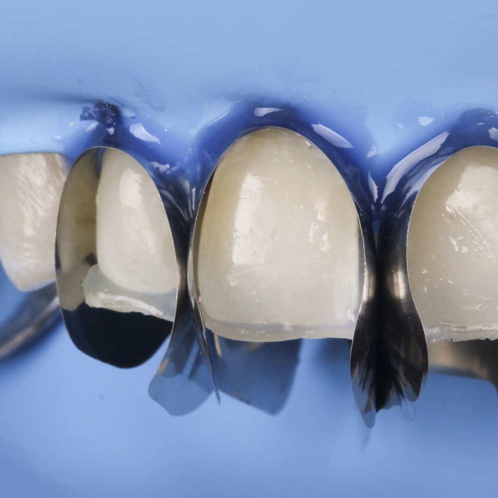 Polydentia Unica Anterior Matrix System Intro Kit