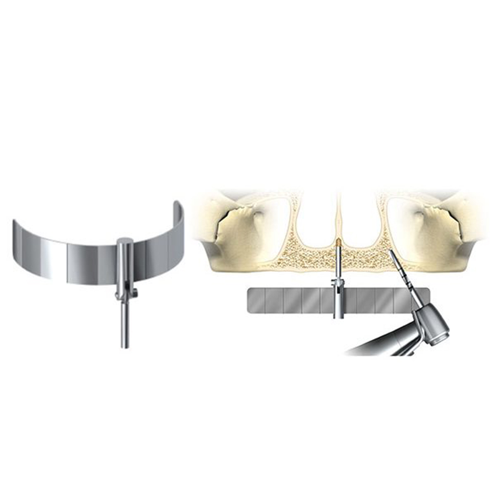 Julldent All on 4 Guide