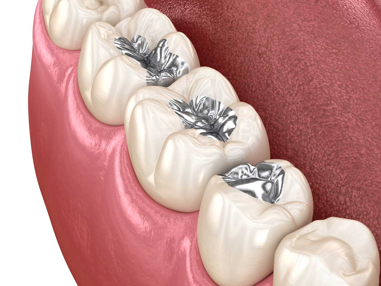 Dpi Dental Amalgam Alloy-Non-Gamma 2