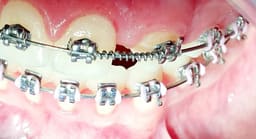 U Ortho NiTi Open Spring 0.010 Inch 180mm - 9