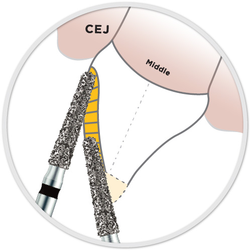 TriHawk Zirconia Cutting Bur FG - 198-018XC