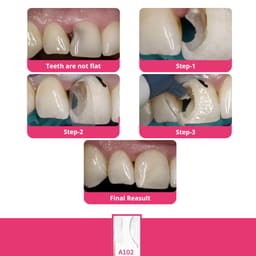 Bioclear Anterior Matrix Closure Series - 10
