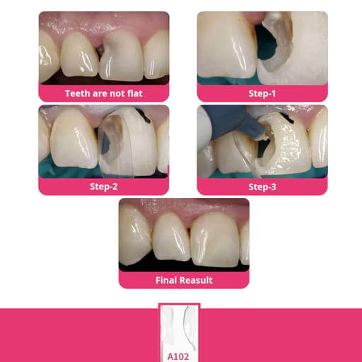Bioclear Anterior Matrix Closure Series