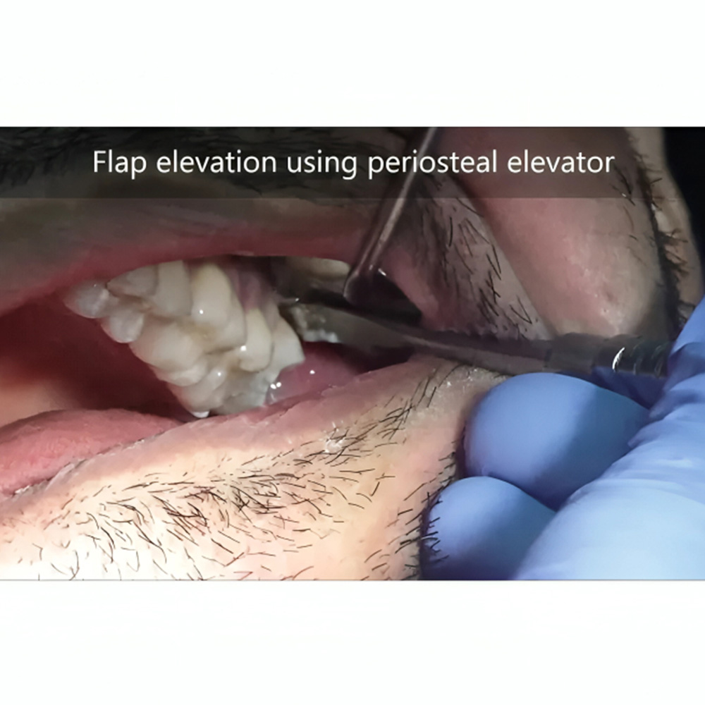 Oracraft Periosteal Elevators