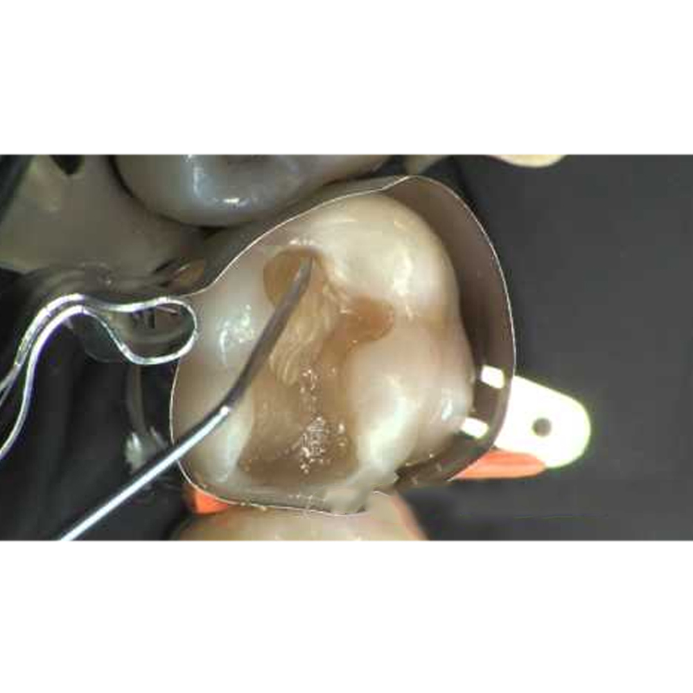 GDC Restore Instrument - Applica