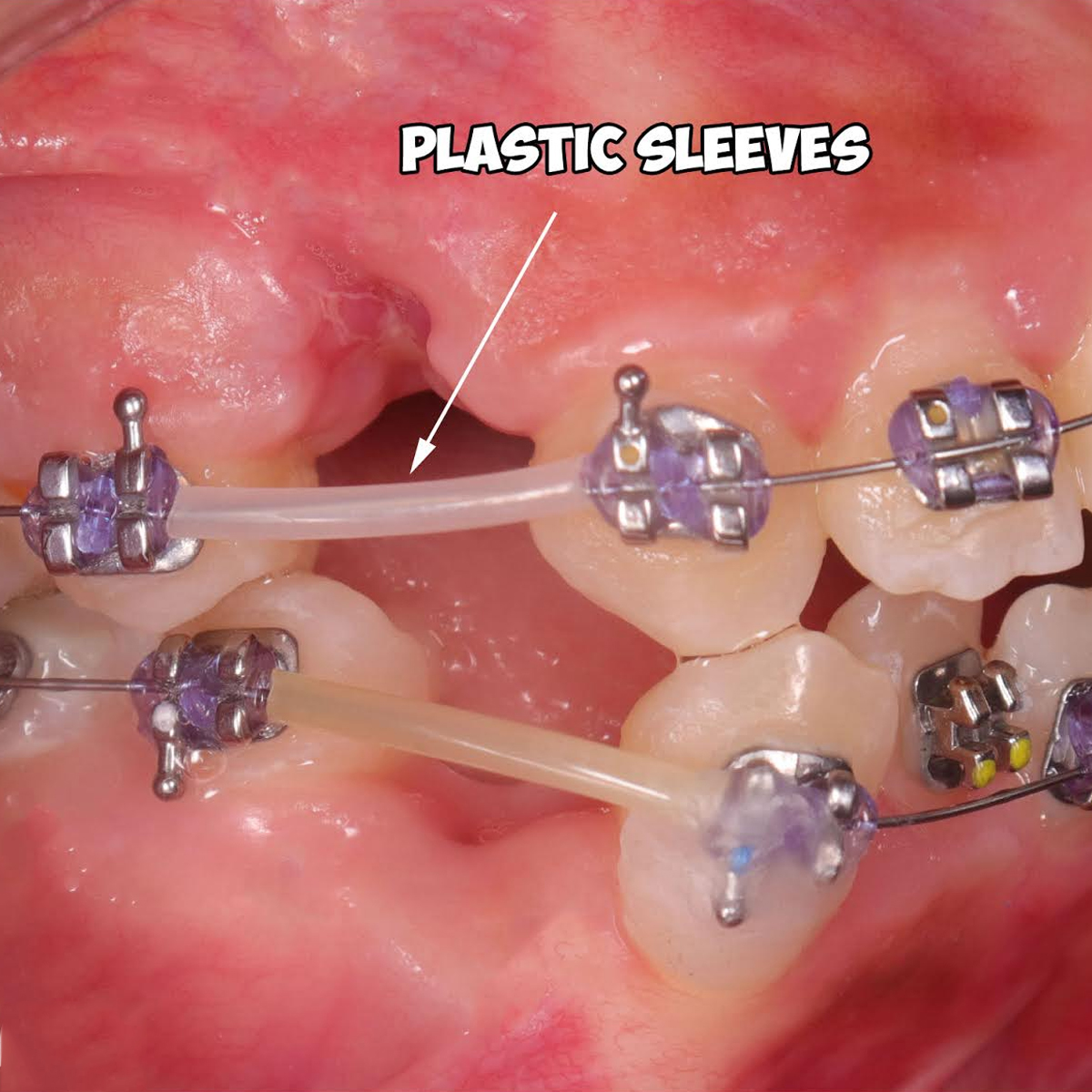 Prime Ortho 0.028 Archwire Sleeves