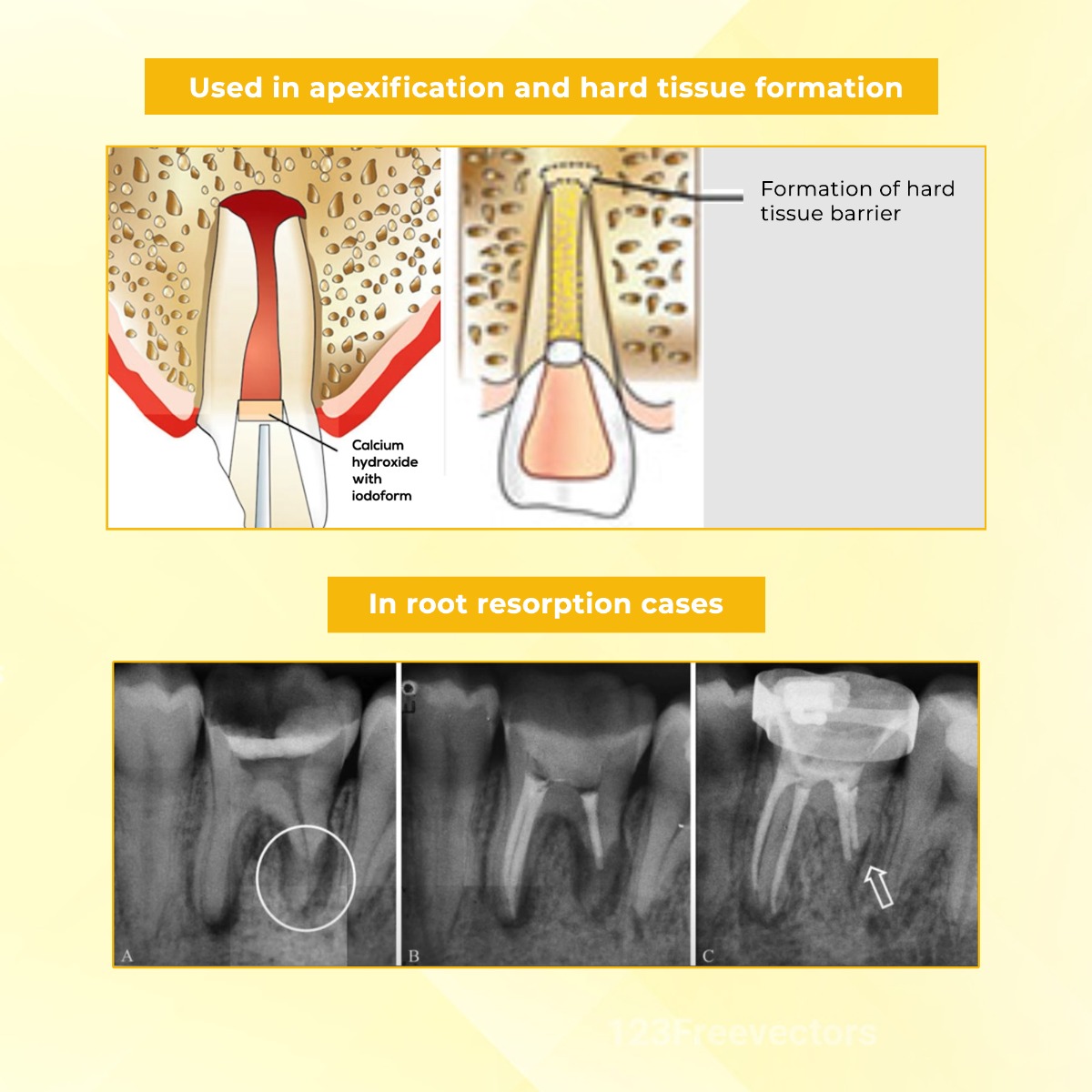 Waldent RCTpex Root Canal Filling Material (Radiopaque) 