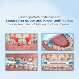 Waldent Blue Bite-Block - 14