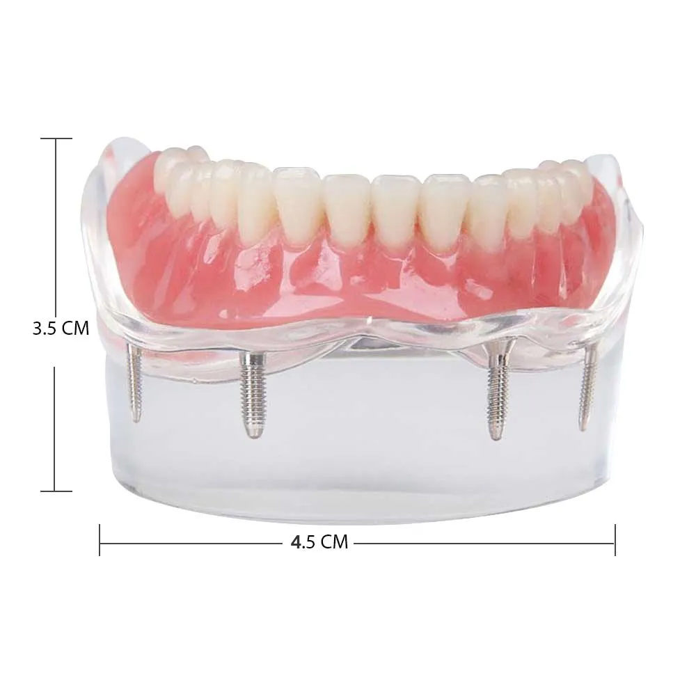 iDENTical Mandibular Overdenture Model with 4 Implants M6003