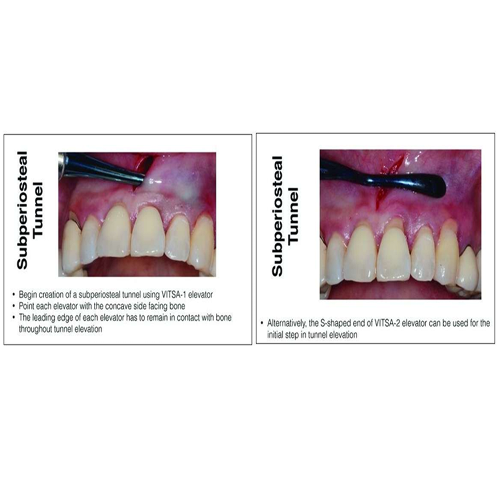 Julldent Vista Tunneling Kit Set of 6 