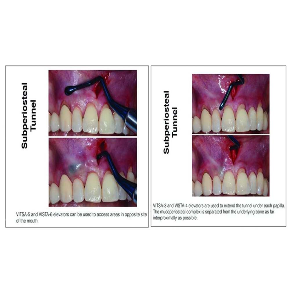 Julldent Vista Tunneling Kit Set of 6 