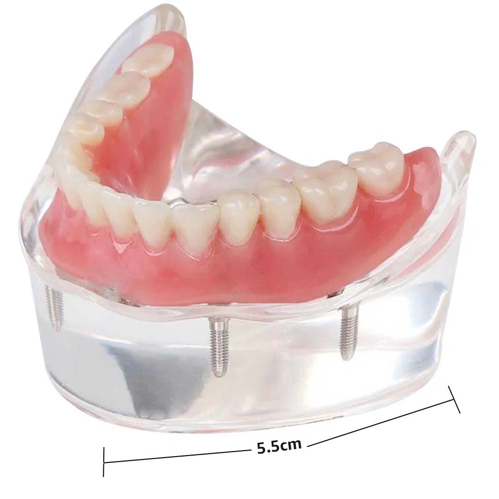 iDENTical Mandibular Overdenture Model with 4 Implants M6003