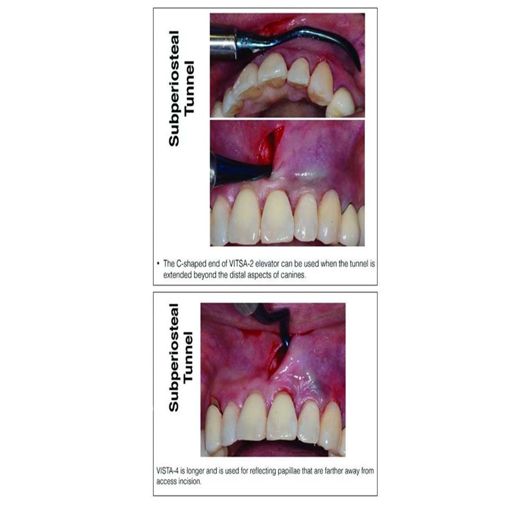 Julldent Vista Tunneling Kit Set of 6 