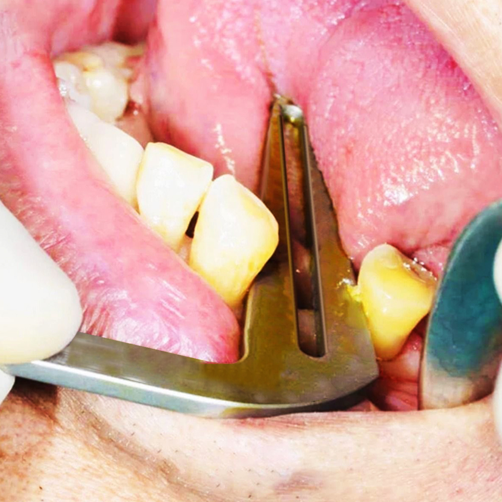 Julldent Universal Centering Guide