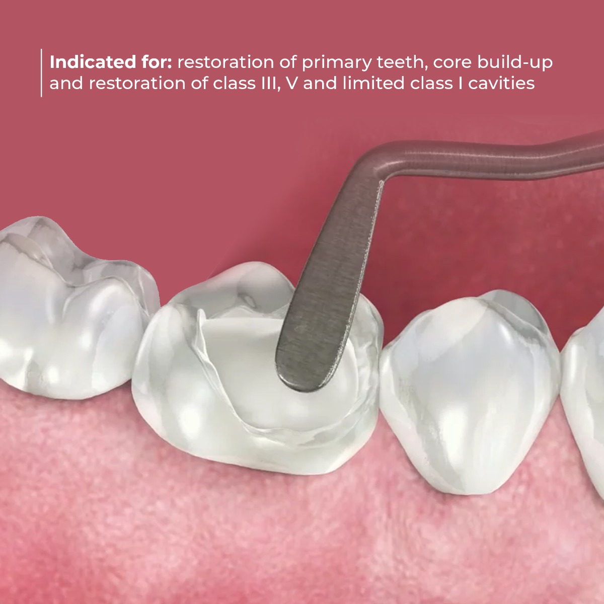 DentGist Bio Glass Gold Restorative GIC (Big Pack)