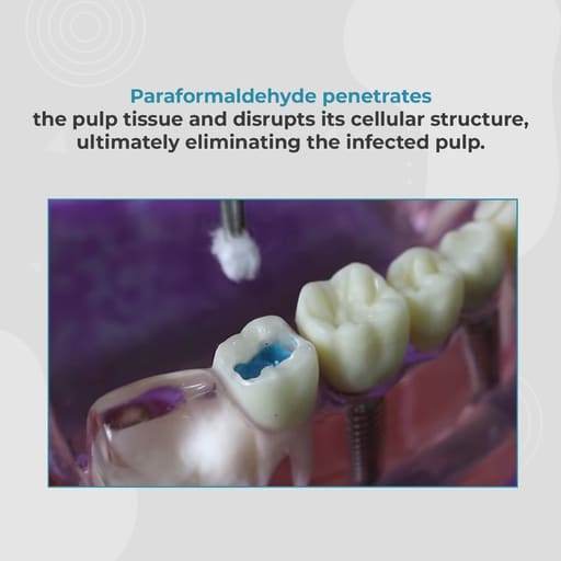Waldent Devital Pulp Devitalizing Paste 