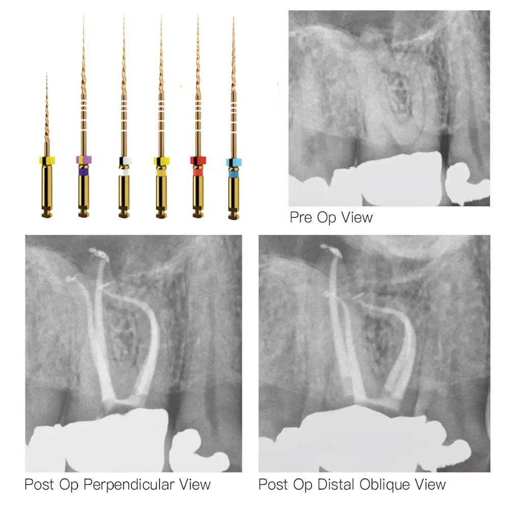 Waldent Premium Taper Gold Rotary Files - 31mm