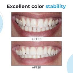 Waldent NanoFill Zirconium Composite Kit - 17