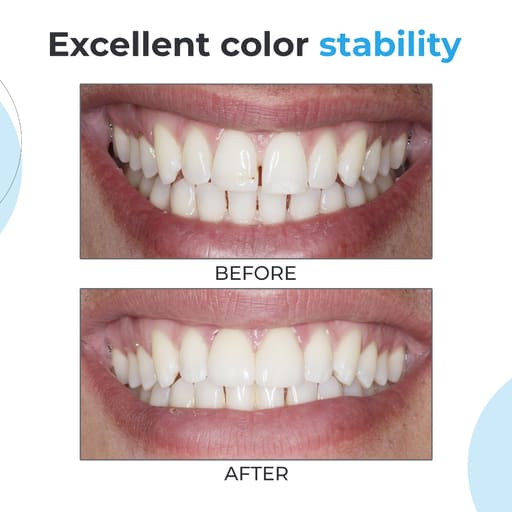 Waldent NanoFill Zirconium Composite Kit