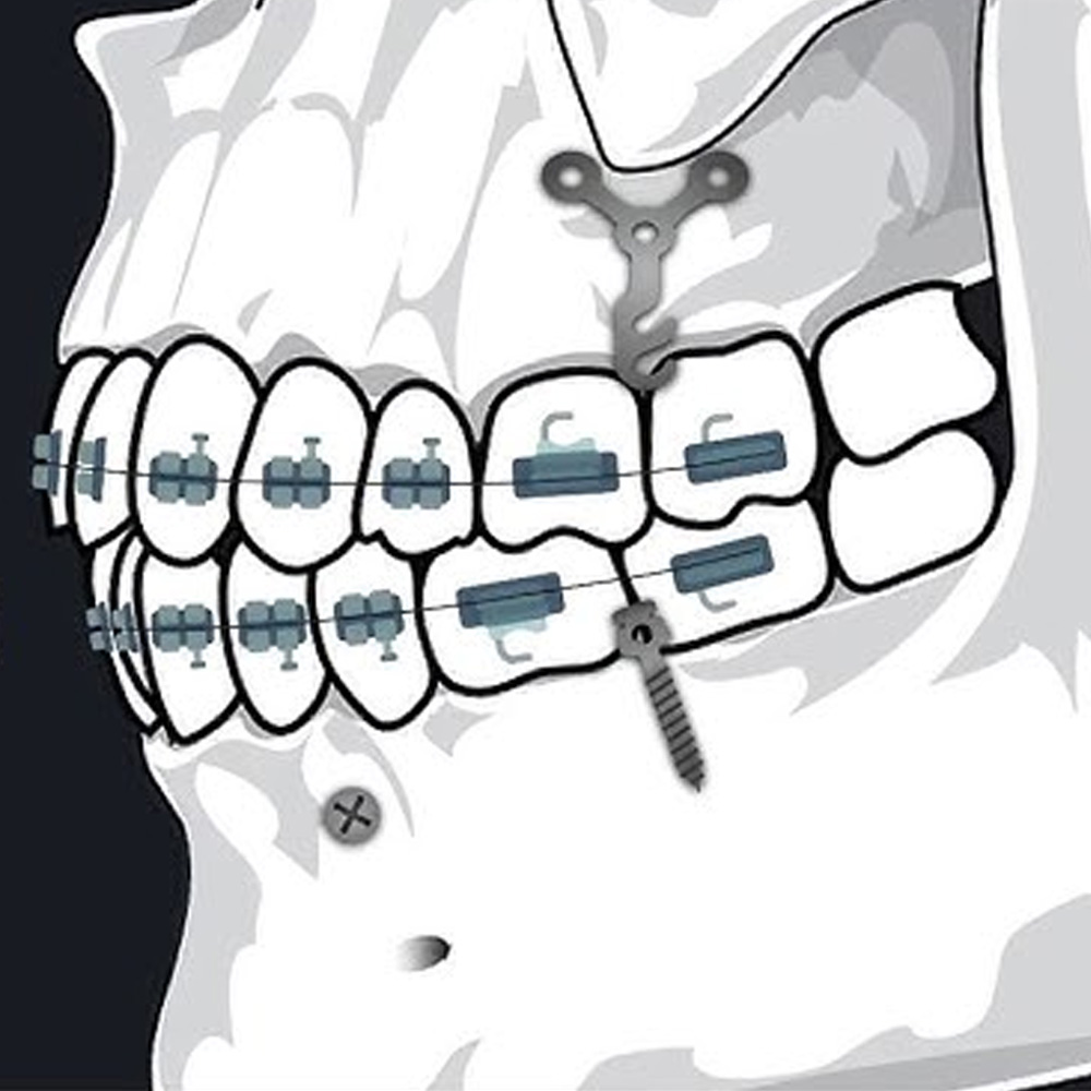 SK Surgicals Orthodontic Titanium Mini Anchorage Plate Y Shape - 2mm