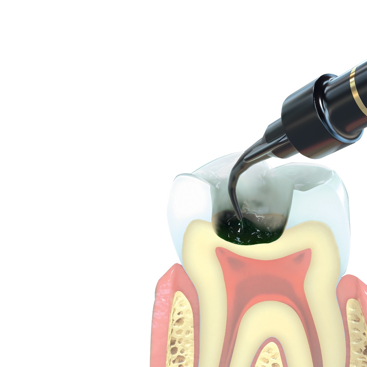 Ultradent Sable Seek - Refills