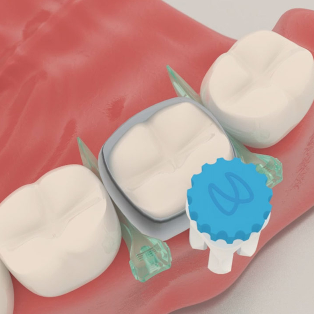 Polydentia Quickmat All-Round Circumferential Matrices