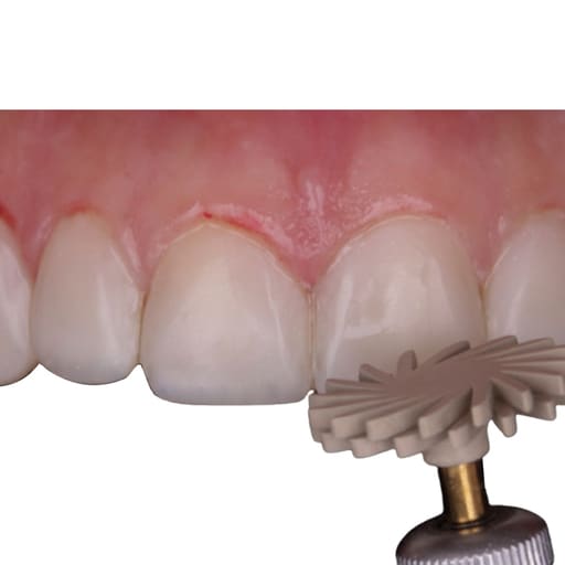 ET Dental Composite Polishing Spiral Disc Kit