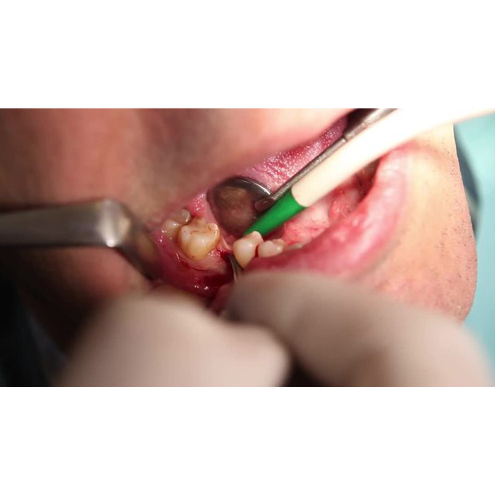 GDC Austin Cheek Retractor Halfmoon (Tra3)