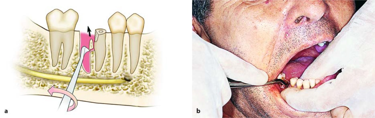 Waldent Root Elevators Premium Set of 11 (K2/2)