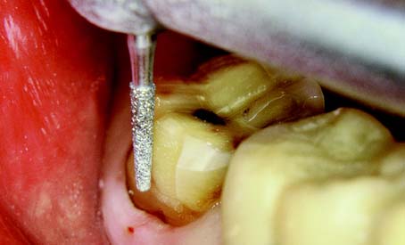 Mani Diamond Burs - Coarse / C Series