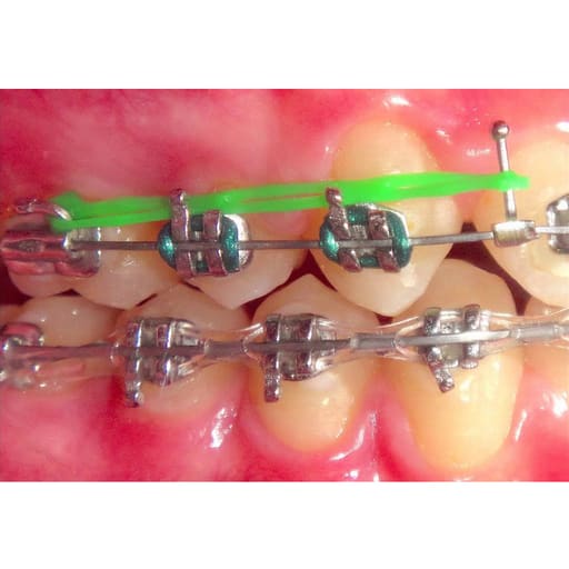 Ortho Direct Crimpable Ball Hooks