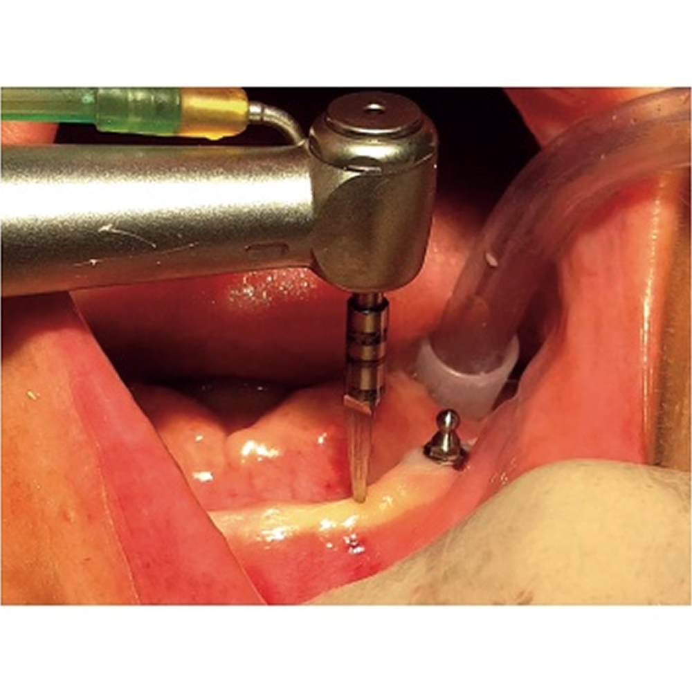 Julldent Basal Drill Kit and Refills