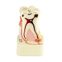 iDENTical 4X Pathologies Of Tooth Model - M4015 - 1